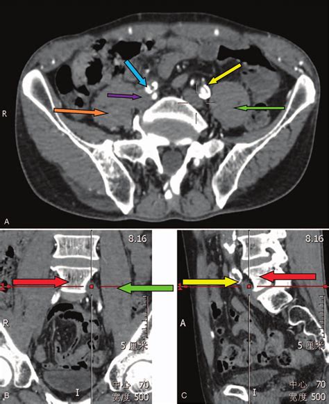 Three Dimensional Cta Of The Common Iliac Vein A Lumbar Cta