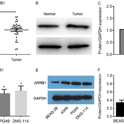 Arrb Expression Levels Are Upregulated In Nsclc Tissues And Cells