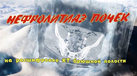 ГЕПАТОМЕГАЛИЯ печени, КАМНИ в почках и НЕФРОЛИТИАЗ на расшифровке КТ ...