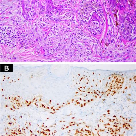 A Acral Lentiginous Melanoma In Situ With Adnexotropism Download