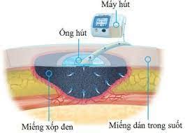 Hút áp lực âm liên tục trong 24h điều trị vết thương