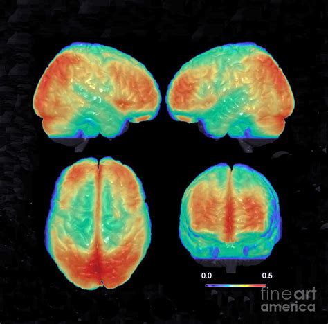 Bipolar Brain 3d Mri Scan Photograph By Science Source Pixels