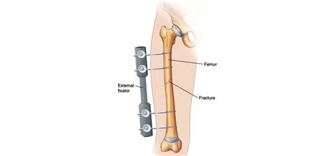 Fracture Fixation Dr Atul Patil