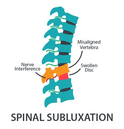 spine-subluxation