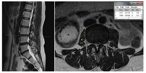 Psoas Muscle X Ray