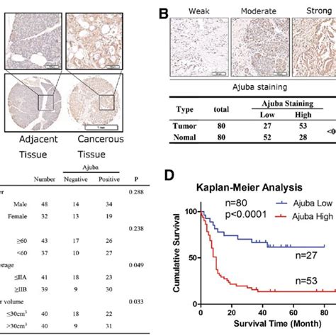 High Expression Of Ajuba Predicts Poor Prognosis In Pdac A Expression