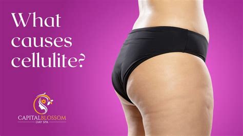 What Causes Cellulite: Exploring the Underlying Factors