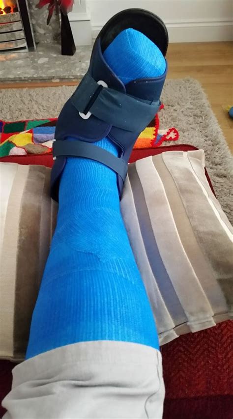 Total Contact Cast Blue Leg Cast Broken Ankle Long Leg Cast