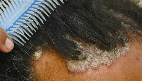 Scalp Rash: Itch Relief and Main Causes