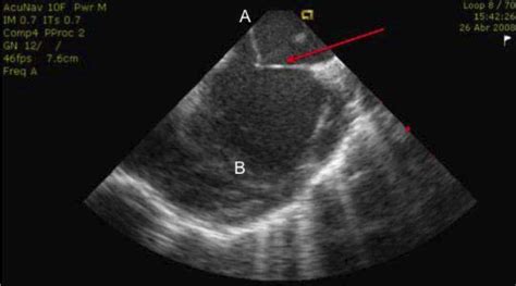 Image Of The Intracardiac Echocardiogram During Transseptal Puncture