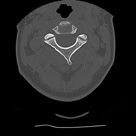 File Normal Trauma Chest Pelvis And Spine Imaging Radiopaedia