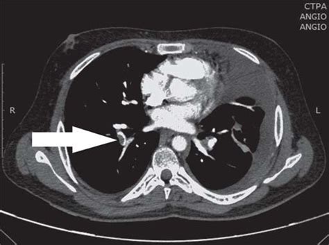 Computed Tomography Pulmonary Angiography Ctpa Showing Right Lower Download Scientific