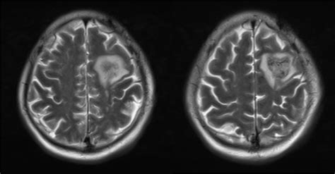 Head MRI shows abnormal signals in the left frontal lobe. Combined with... | Download Scientific ...