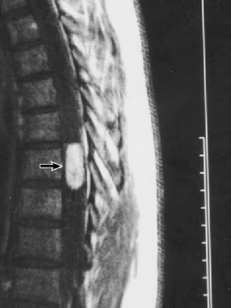 Figure 1 From Intramedullary Spindle Cell Hemangioendothelioma Of The