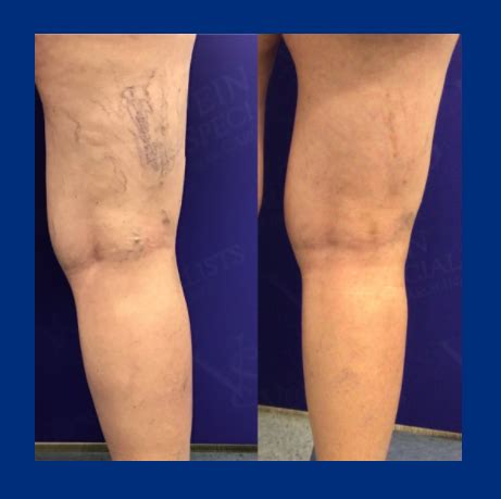 What Is Sclerotherapy Vein Specialists Of The Carolinas