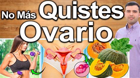 ELIMINA QUISTES EN LOS OVARIOS EN 1 SEMANA Cómo Eliminar Ovarios