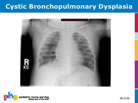 An Overview of Bronchopumonary Displasia (BPD)