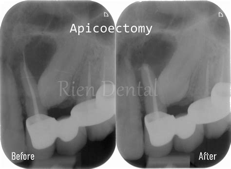 Apicoectomy Root Canal Surgery