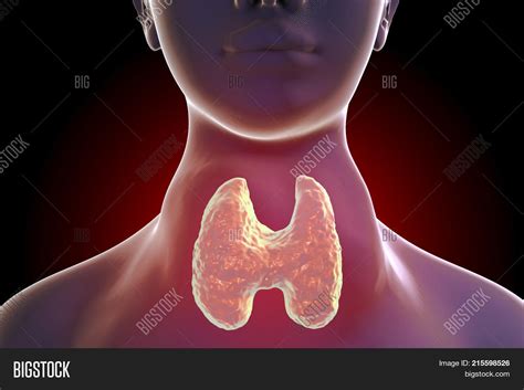 Toxic Diffuse Goiter Image Photo Free Trial Bigstock