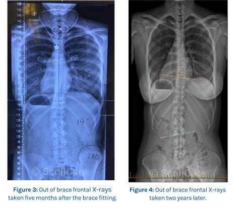 Case 14 Year Old Female Adolescent Patient ScoliBrace