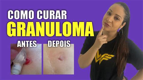 Como Curar Granuloma Definitivamente YouTube