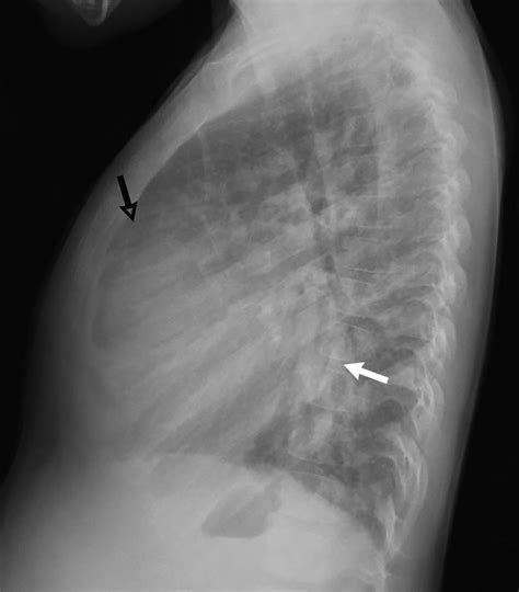 Cyanotic And Acyanotic Congenital Heart Disease Radiology Key