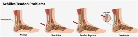 Myo Therapy And Healthcare Institute Achilles Tendinopathy