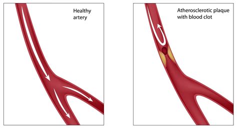 Hardening Of The Arteries