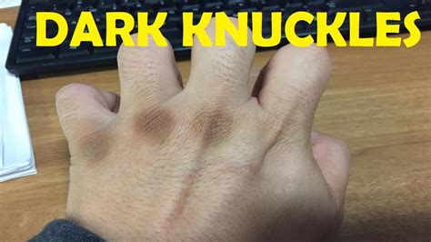 How To Get Rid Of Dark Knuckles On Hands And Toes YouTube