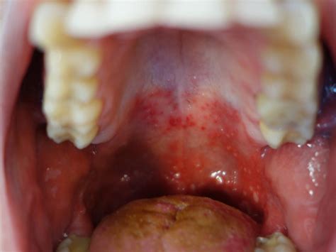 Yellow Bumps On Back Of Throat