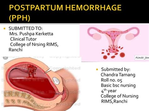 Post Partum Hemorrhage Obs And Gyne Ppt Free Download