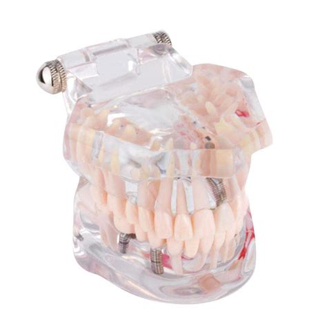 Buy Cocoarm Dental Teeth Model Dental Im Model Teeth Model Detachable