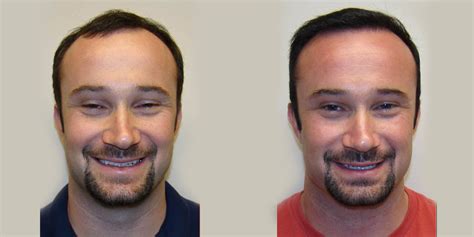 How To Reverse Balding In One Maxharvest™ Procedure Dr Brett Bolton