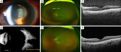 A Case Of Non Infectious Posterior Scleritis A 57 Year Old Woman