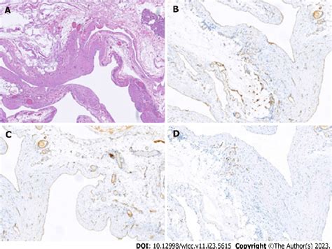 Figure 2 From Pancreatic Cavernous Hemangioma Complicated With Chronic