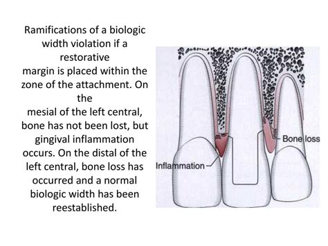 Biologic Width