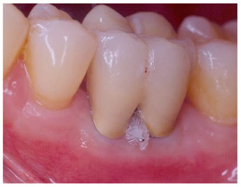 Dentistry Journal Free Full Text Furcation Involvement