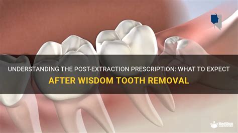 Understanding The Post Extraction Prescription What To Expect After Wisdom Tooth Removal Medshun