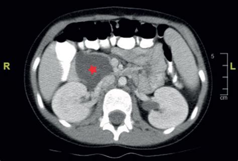 Computed Tomographic Scan Of The Abdomen Revealed A Large Cystic Lesion