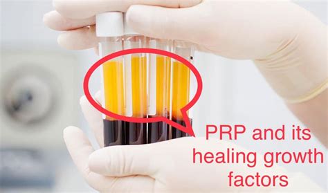 Platelet Rich Plasma Prp Injections Dr Kevin Pauza