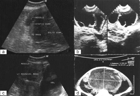 Ultrasonography scan showing (a) right adnexal mass (serous... | Download Scientific Diagram