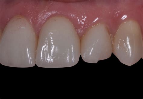 How Long Do Veneers Last City Dental