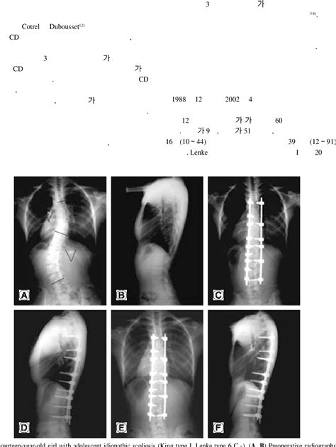 Figure 1 From Posterior Correction Of Idiopathic Scoliosis With Using Transpedicular Screw