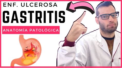 Anatomía Patológica Enfermedad Ulcerosa Y Gastritis Youtube