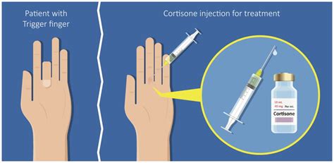 Trigger Finger Injection How Effective Is It Sport Doctor London