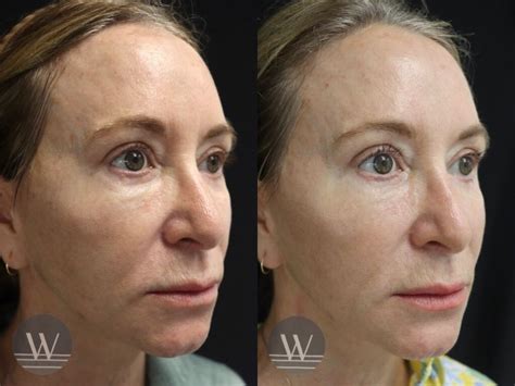 Fractional Laser Resurfacing Case 7774 West Institute Chevy Chase