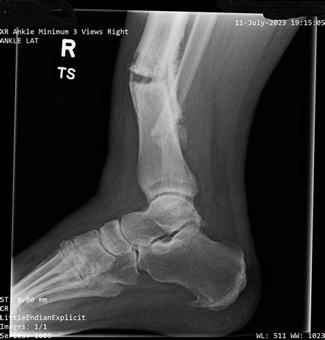 Broken Tibia Fibula What Sort Of Recovery Time Am I Looking At R Brokenbones