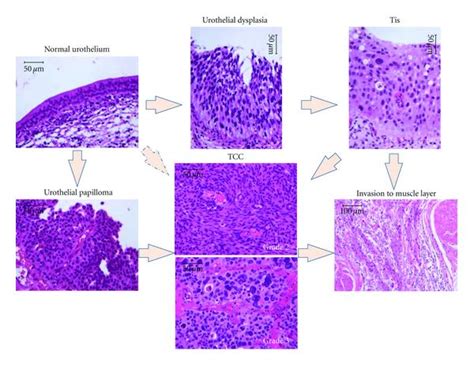 Transitional Cell Carcinoma