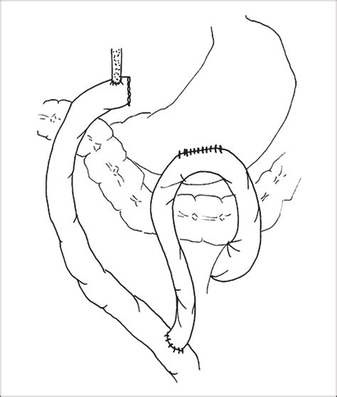 Combined Gastric And Biliary Bypass For The Treatment Of Obstructive