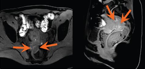 A Multidisciplinary Approach To The Patient With Deep Infiltrating Endometriosis